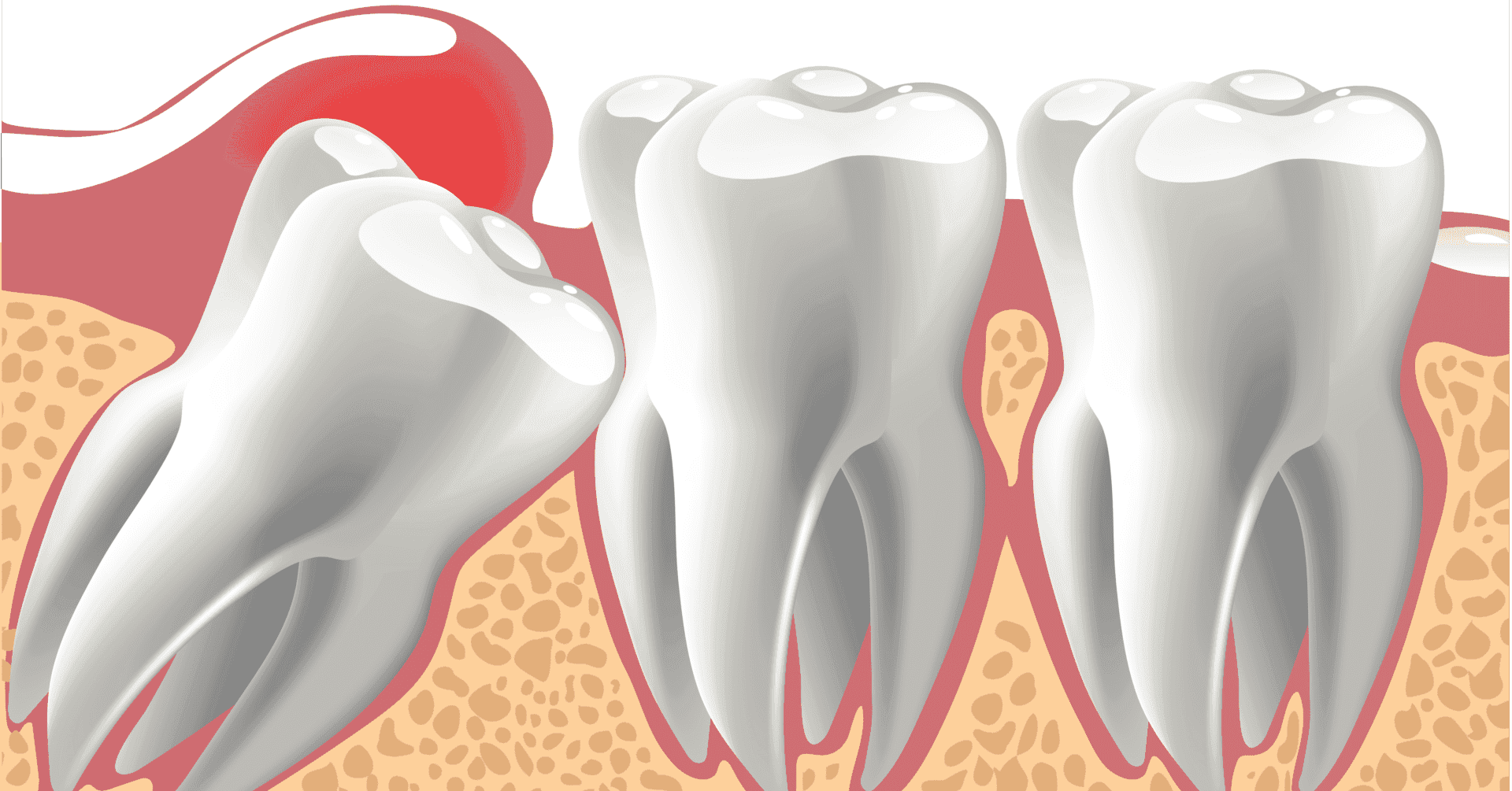 Impacted Tooth 01