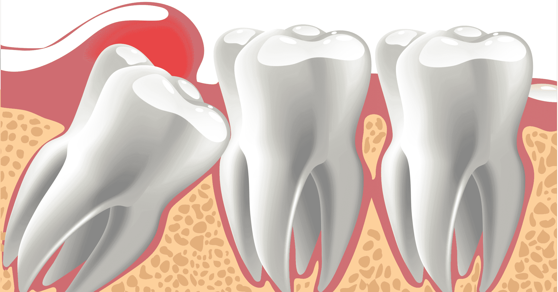 impacted teeth