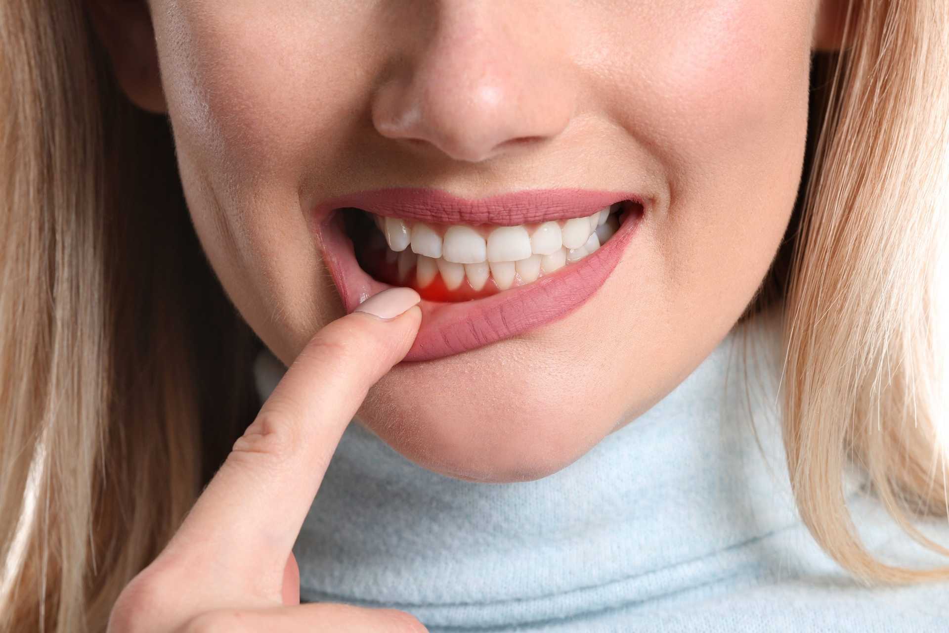 Picture of woman pulling on bottom lip to show red gums
