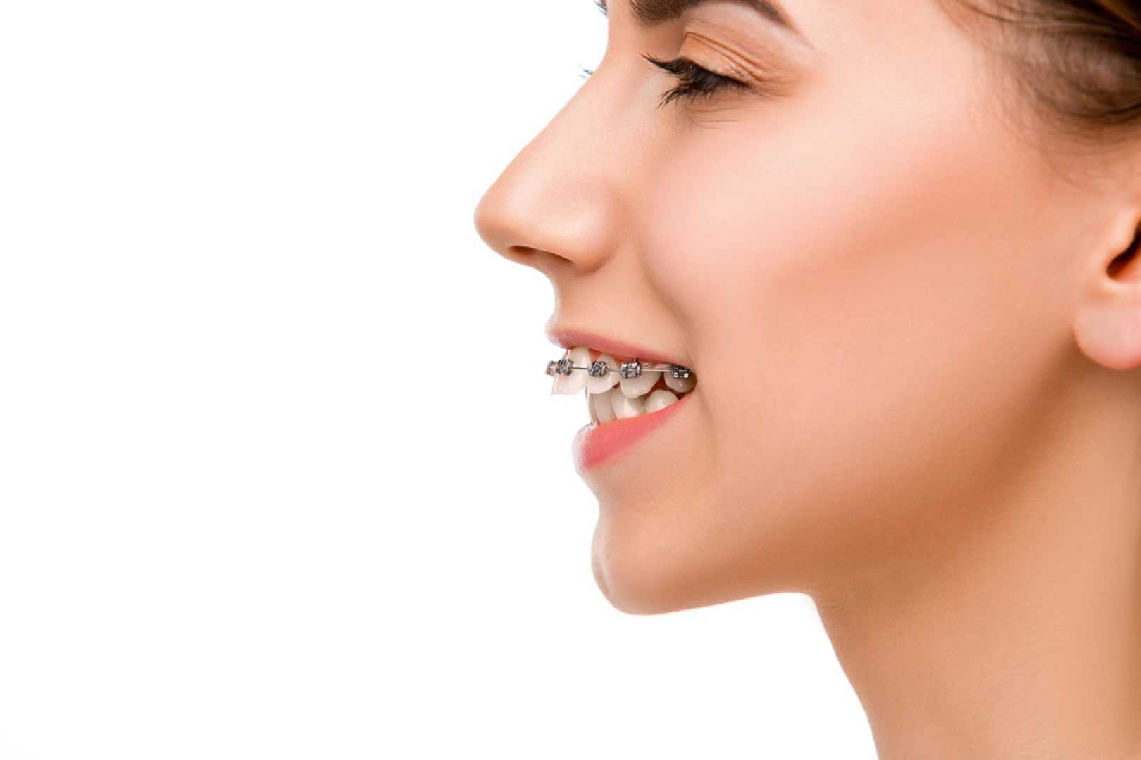 What Is an Overbite and How Can It Be Fixed?