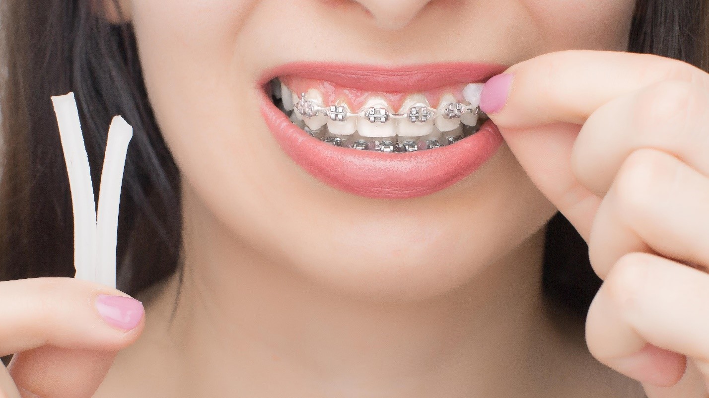 Girl applies orthodontic wax and wonders, “can you eat with orthodontic wax?”