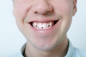 Crossbite vs underbite