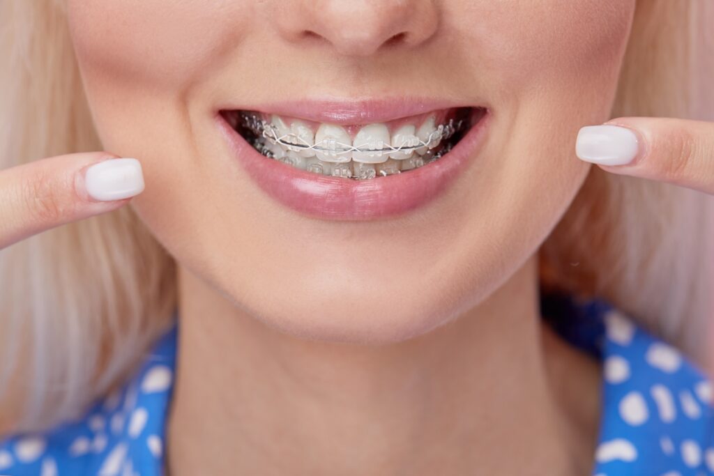 Do clear braces stain