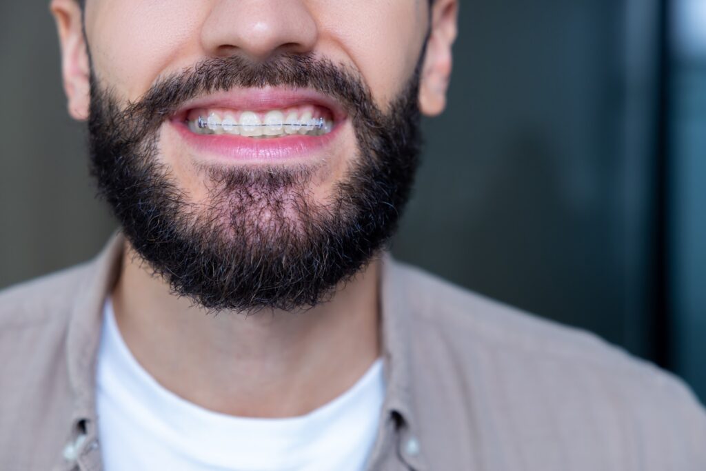 clear braces treatment time