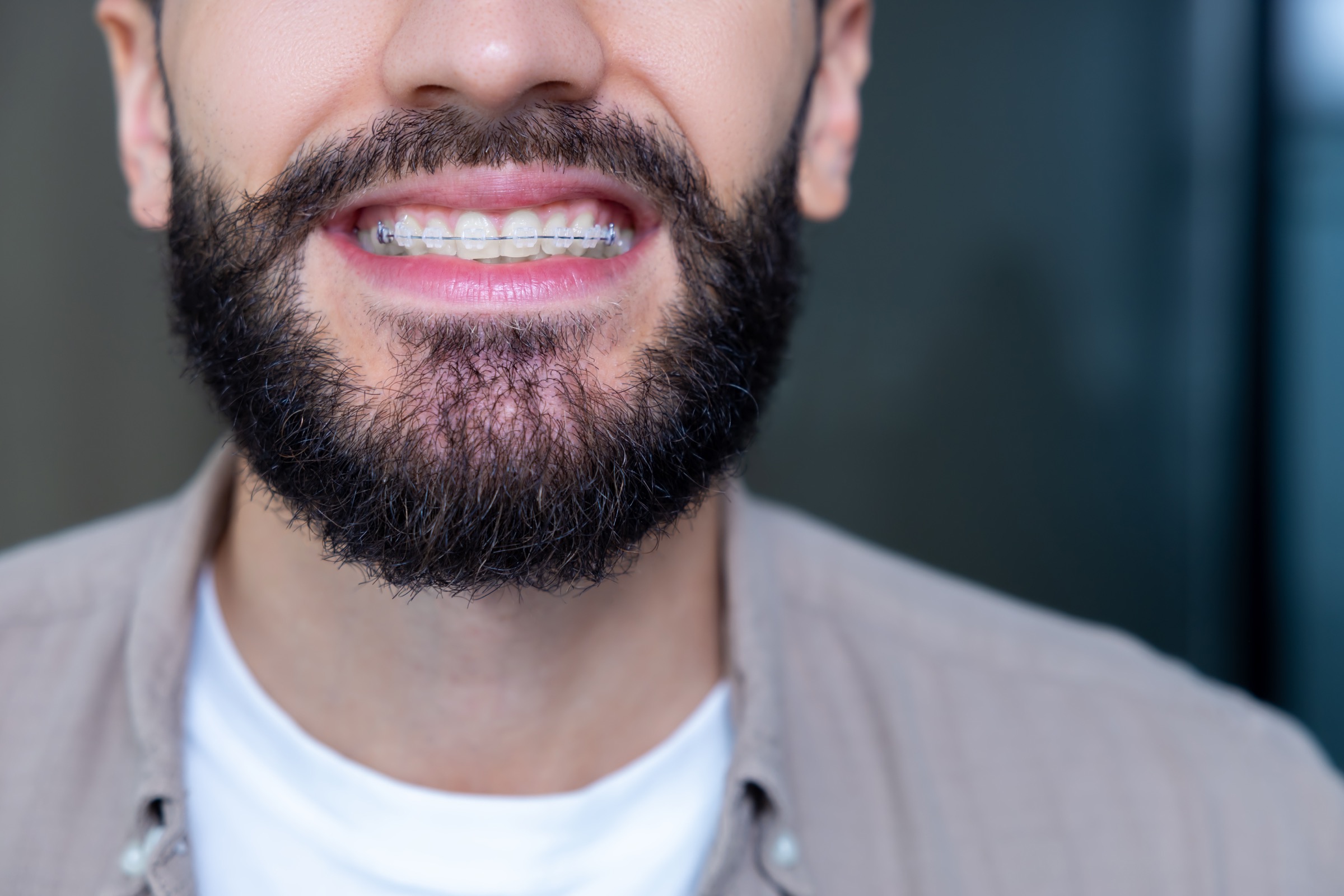 clear braces treatment time