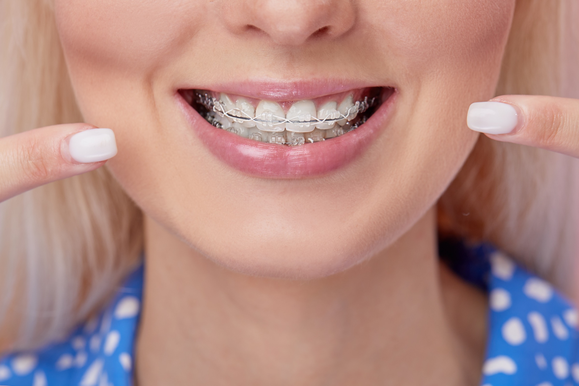 Do clear braces stain